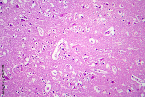 Histopathology of Japanese encephalitis, light micrograph photo