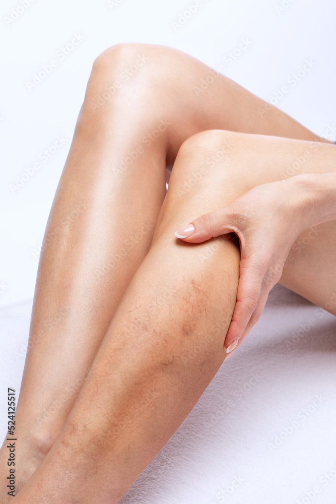 Fototapeta premium Beautiful slender woman sits on a couch in a spa salon. She shows varicose veins in the lower legs.Treatment of varicose veins and capillaries.