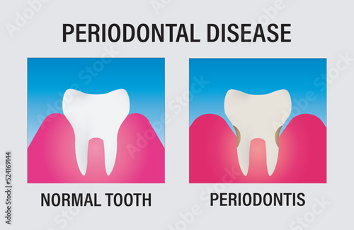 Periodontal Disease Chart Vector Illustration