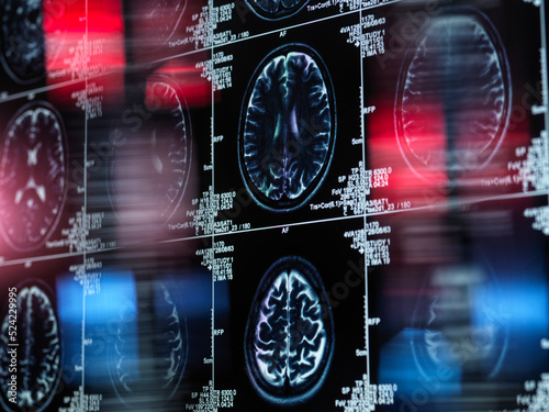 Alzheimer's and dementia research, conceptual image