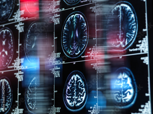 Alzheimer's and dementia research, conceptual image
