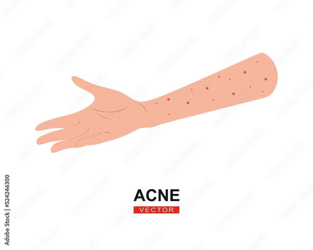Thumbnail for Hand Skin Acne Treatment