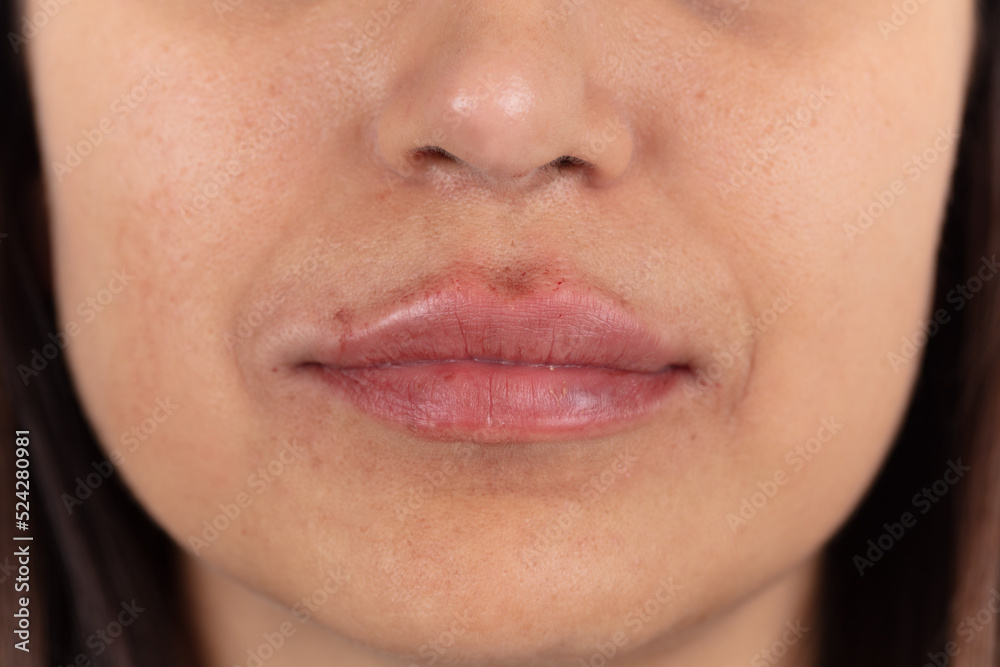 Obraz premium Close-up of female lips after augmentation. 