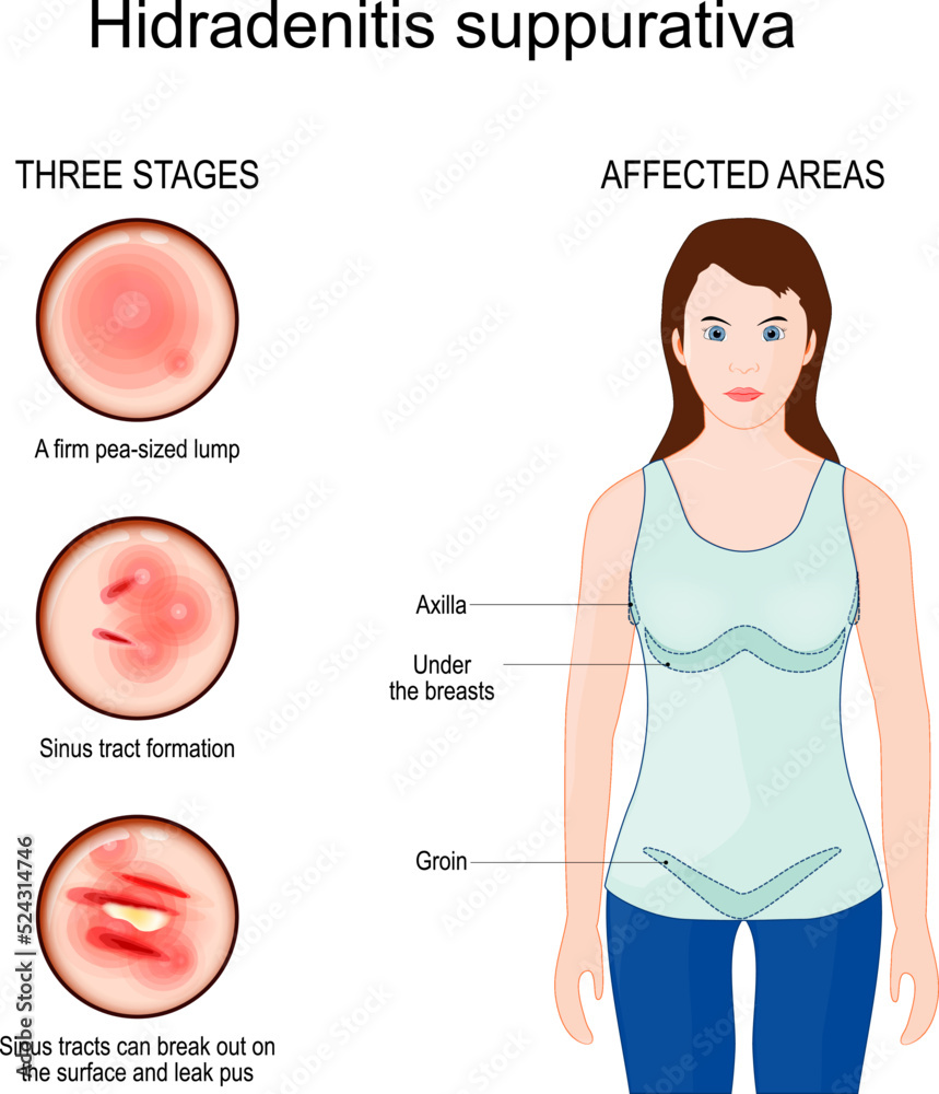 Photo & Art Print Hidradenitis suppurativa. Affected areas of acne ...