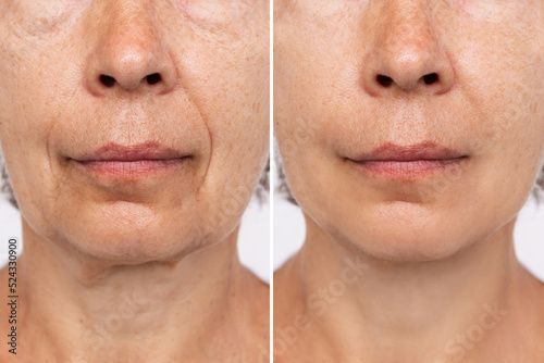 Obraz na płótnie Lower part of face and neck of an elderly woman with signs of skin aging before after facelift, plastic surgery