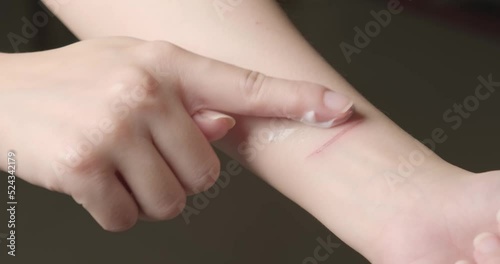 Closeup blisters, a woman applying scars removal cream to heal the first degree - heat burn wound on her hand caused by hot cooking oil spill. Finger using a cream on treat fire burns in skin