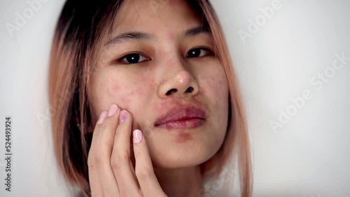 Asian woman is scratching her face from Skin Allergy infected illness. with red rash on her face.