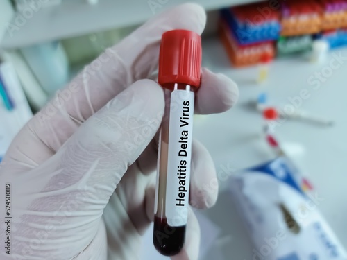 Doctor hold Blood sample for Hepatitis Delta virus test tube. HealthCare and medical concept. photo