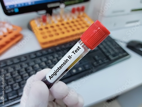 Biochemist of Scientist holds blood sample for Angiotensin II test. Medical test tube in laboratory background.