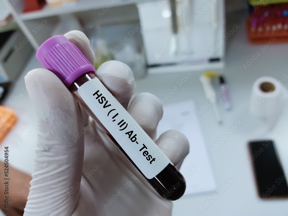 Biochemist of doctor holds blood sample for HSV 1 and HSV 2 test. Medical test tube in laboratory background.