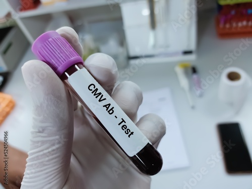 Biochemist of Scientist holds blood sample for cytomegalovirus (CMV) antibody test. Medical test tube in laboratory background. photo