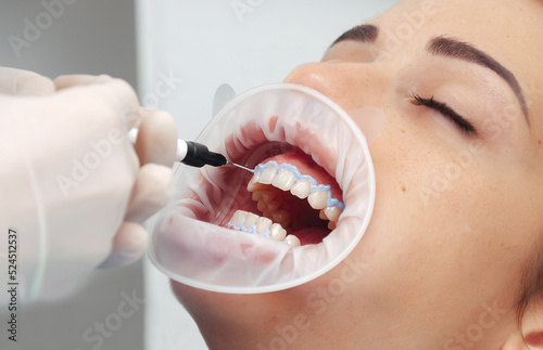 Obraz na plátně Young patient relaxed with eyes closed and cheek separators while the dentist performs teeth whitening in his office