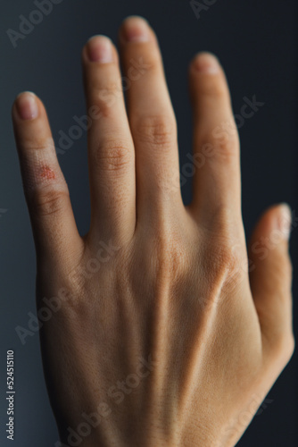 A beautiful woman's palm with a wounded finger © alexbutko_com
