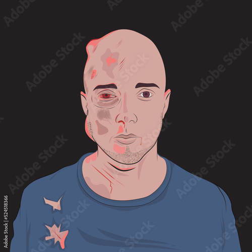 White man after an accident. Blows to the face and body.