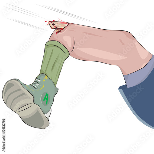 Broken leg, exposed femur fracture.