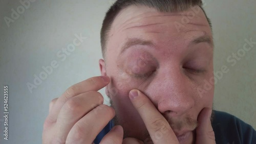 Eye disease red eyes conjunctivitis a man with a beard smears his eyes with ointment on the background of the wall. High quality 4k footage