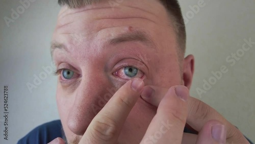 Eye disease red eyes conjunctivitis a man with a beard smears his eyes with ointment on the background of the wall. High quality 4k footage