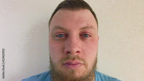 Eye disease red eyes conjunctivitis man with beard looking at camera. High quality 4k footage