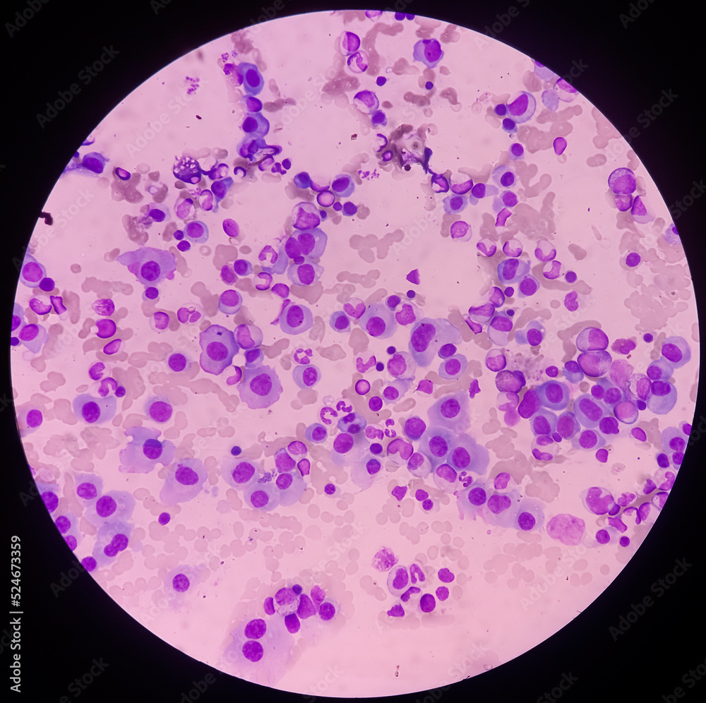Microscopic image of bone marrow. Plasma cell dyscrasia or Multiple