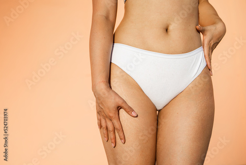 Stretch marks on female legs. A woman's hand holds a fat cellulite and a stretch mark on her leg. Cellulite close-up.