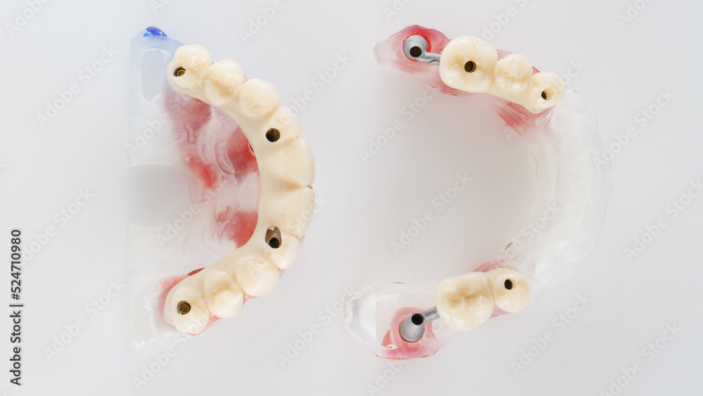 top view of a dental model with temporary resin dentures on a white background top view of a dental model with temporary resin dentures on a white background
