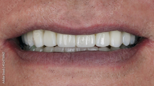 smile of an elderly man with ceramic prostheses of the highest category