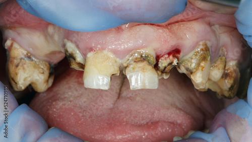 upper jaw of an unhealthy person with rotten teeth