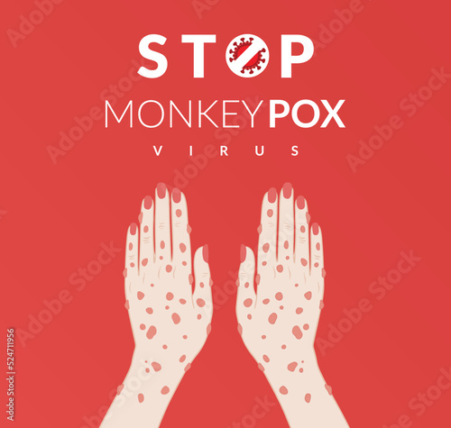 Monkeypox virus banner for awareness and alert against disease spread, Hand rash with monkeypox. Monkey Pox virus outbreak pandemic, pidemic from animals to humans. Monkeypox virus background