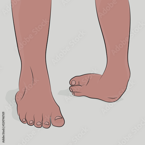 Foot deformation, foot mutation, legs in an upright position.