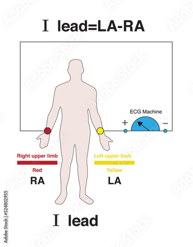 The positive electrode of lead I of the electrocardiogram is placed on the left upper limb, and the negative electrode is placed on the right upper extremity, which is a standard bipolar limb lead.