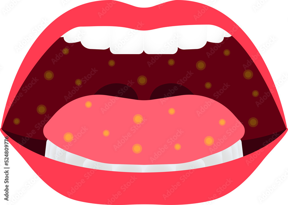 Obraz premium mouth disease. enteroviruses name of virus. be careful of your chidren and yourself