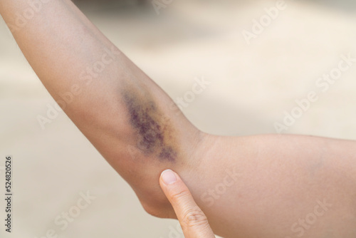 A bruise on forearm with the color of blue and purple is a hematoma of tissue with the background of blurred sand. photo