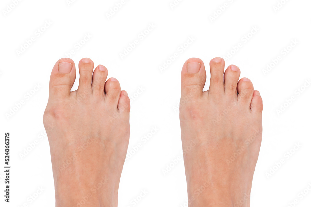 Hallux valgus deformity of the big toe caused by wearing uncomfortable shoes. A woman's  foot before and after treatment  isolated on a white background. Orthodontics  - obrazy, fototapety, plakaty 