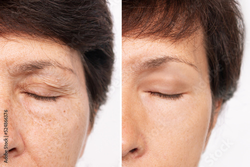 Elderly caucasian woman's face with puffiness under her eyes and wrinkles on eyelids before and after blepharoplasty. Age-related skin changes,fatigue. Result of plastic surgery. Rejuvenation photo