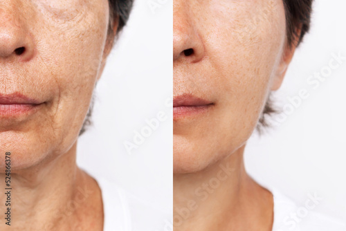 Fotografia Lower part of elderly woman's face and neck with signs of skin aging before after facelift, plastic surgery