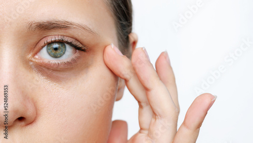 A young caucasian woman demonstrating dark circles under her eyes with hand isolated on a white background. Pale skin, bruises under the eyes are caused by fatigue, lack of sleep, insomnia and stress photo