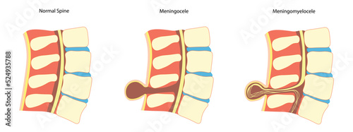 Types of Spina bifida illutration. Side view of a Spine with normal spine, meningocele and meningomyelocele
