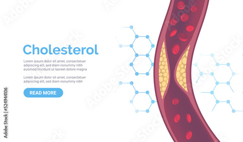 Cholesterol artery thrombosis micro vascular desease. Arteriosclerosis blood vector atherosclerosis risk