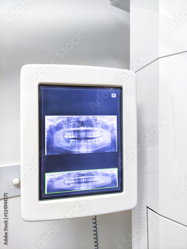 Screen of teeth scan machine in the dental clinic.