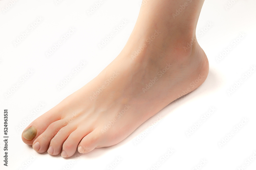 Subungual hematoma in the nail of the right foot. Nail for onycectomy. Nail in purple and black tones. Isolated background white. Close up. Subungual hematoma in the nail of the right foot. Nail for onycectomy. Nail in purple and black tones. Isolated background white. Close up.