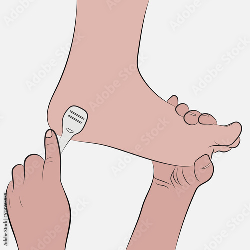 Corns on the heel of the foot, foot maintenance. Vector corns.