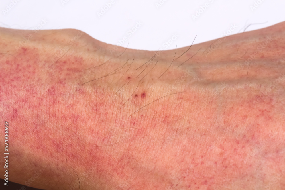 Wrist asian man with allergy red rash on white background Wrist asian man with allergy red rash on white background