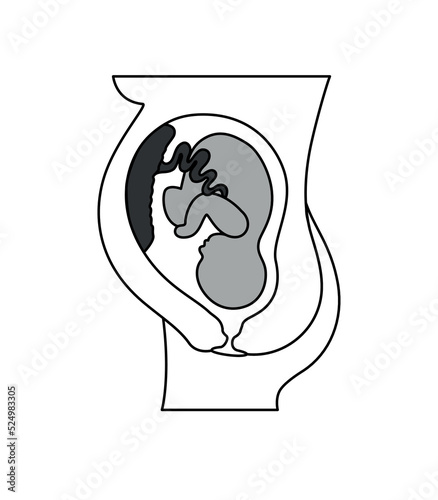 Placental previa. Fetus in Uterus During Pregnancy. Pregnancy women anatomy. Fetus with umbilical cord and placenta.
Usual anatomical Placenta Location. Detailed medical vector illustration.
