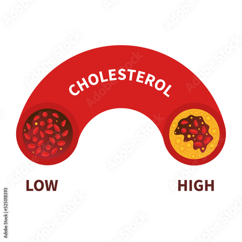 Cholesterol level on blood vessel medical diagram. Meter gauge of ldl and hdl lipoprotein. High and low fat test indicator. Atherosclerosis and thrombus risk. Healthcare concept. Vector illustration.