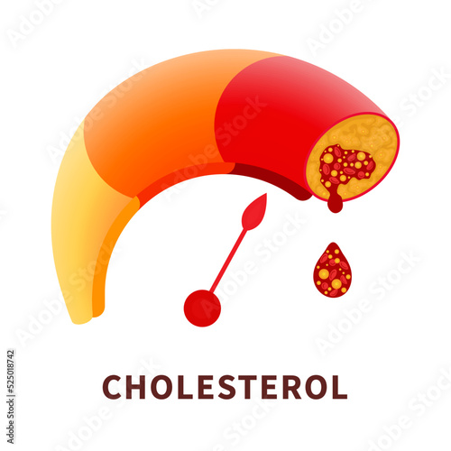 Cholesterol level on blocked blood vessel medical diagram. Meter gauge of ldl and hdl lipoprotein. High and low fat test indicator. Atherosclerosis risk. Healthcare concept. Vector illustration.