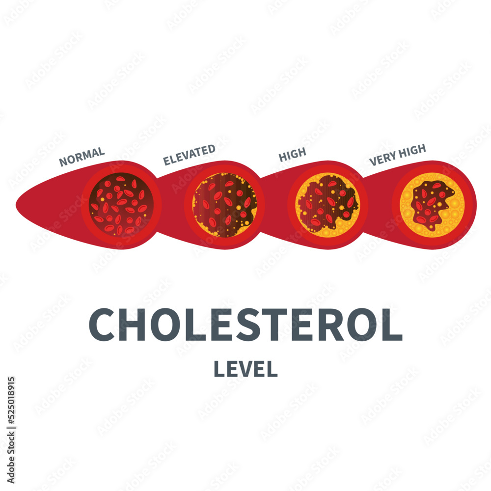 Different stages of cholesterol plaque buildup in artery. Low to high