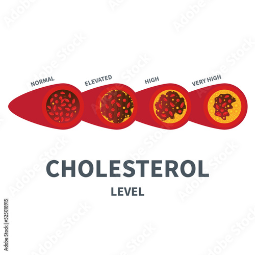 Different stages of cholesterol plaque buildup in artery. Low to high fat count in blood vessel diagram. Meter gauge of ldl and hdl lipoprotein. Atherosclerosis risk indicator. Vector illustration.