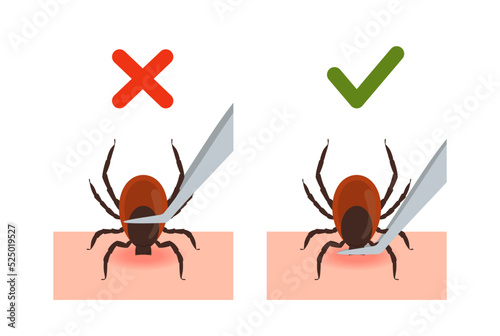 Removing encephalitis tick of skin after bite vector illustration isolated.