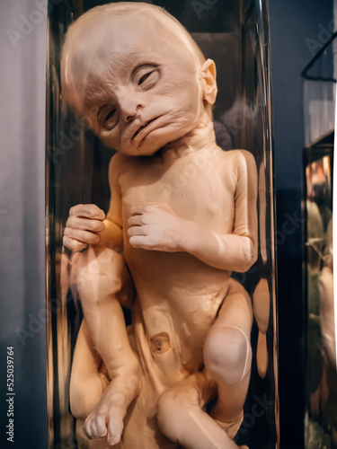 Canvastavla Sample of human fetus with anatomical abnormalities in jar of formaldehyde in cabinet of curiosities close up