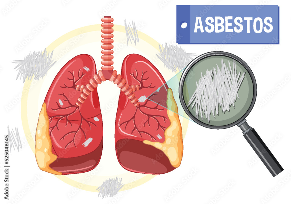 Stunning Lung Disease From Asbestos Photo Art Stunning Lung Disease From Asbestos Photo Art